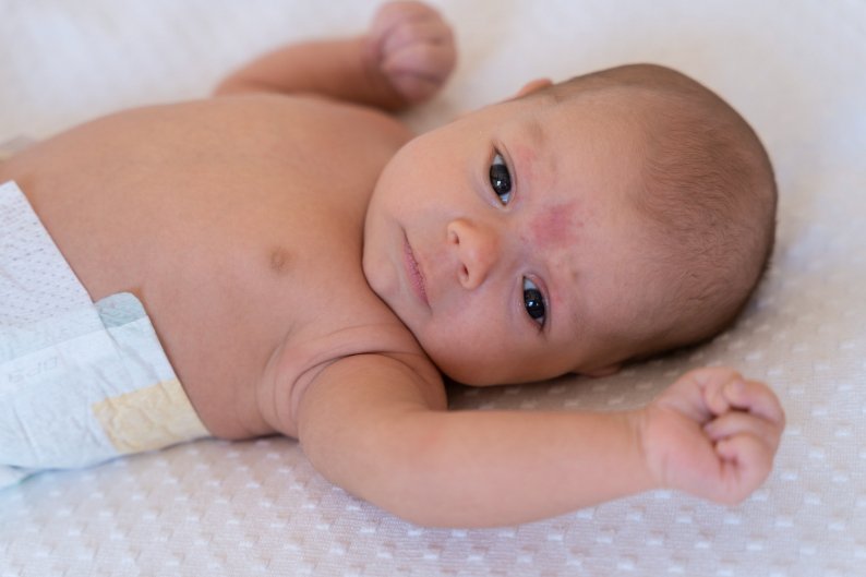 6 Jenis Penyakit Kulit Bayi dan Cara Mengatasinya