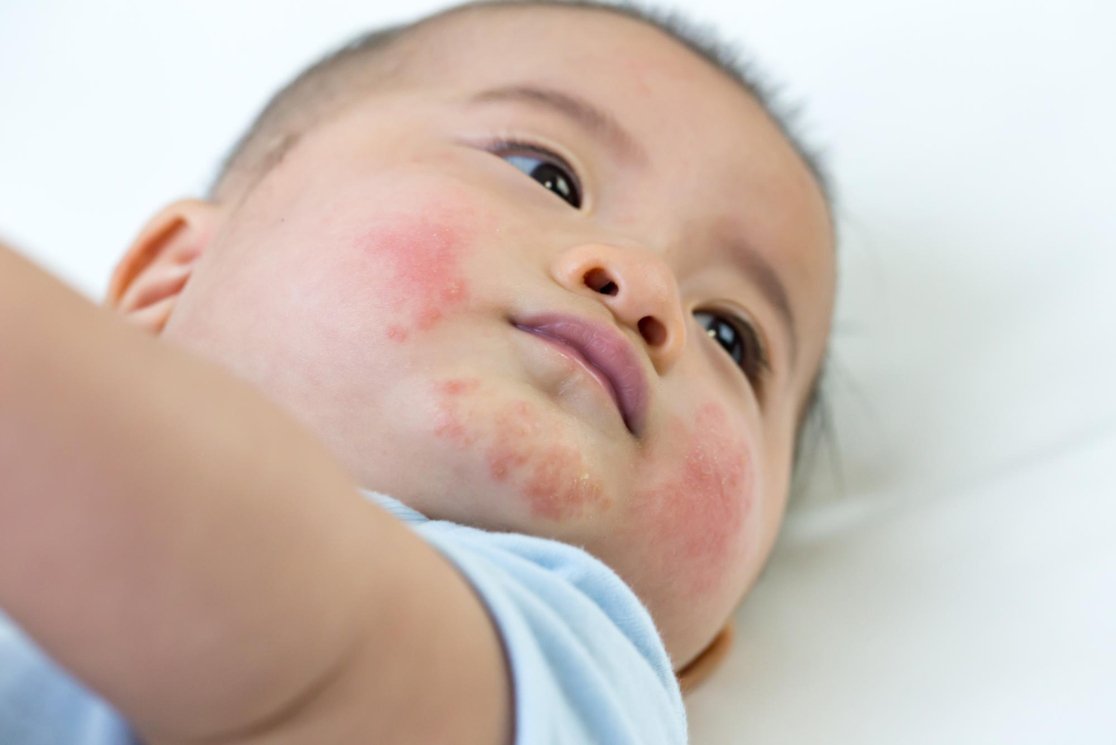 Kenali 7 Penyebab Bintik Merah pada Kulit Bayi Kenali 7 Penyebab Bintik Merah pada Kulit Bayi