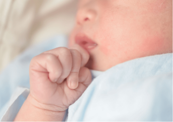 Seputar Kulit Sensitif Pada Bayi yang Wajib Moms Tahu